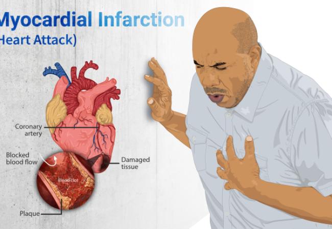 Heart attack wikimedia image